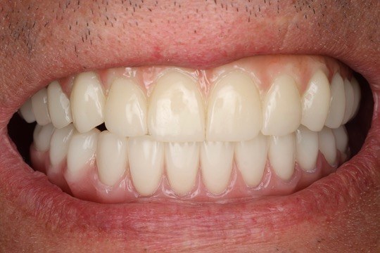 Dental implant smile result — Keystone Dental Studio