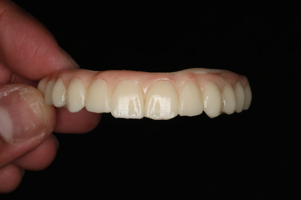 Implant-supported bridge — Keystone Dental Studio