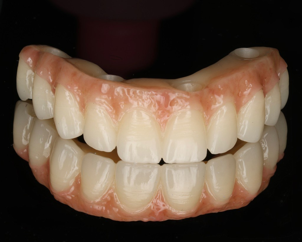 Full-arch implant restoration — Keystone Dental Studio